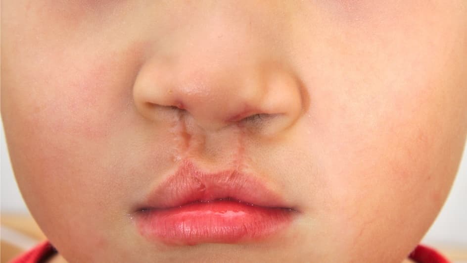 Thumbnail for Craniofacial Conditions: Principles of Management