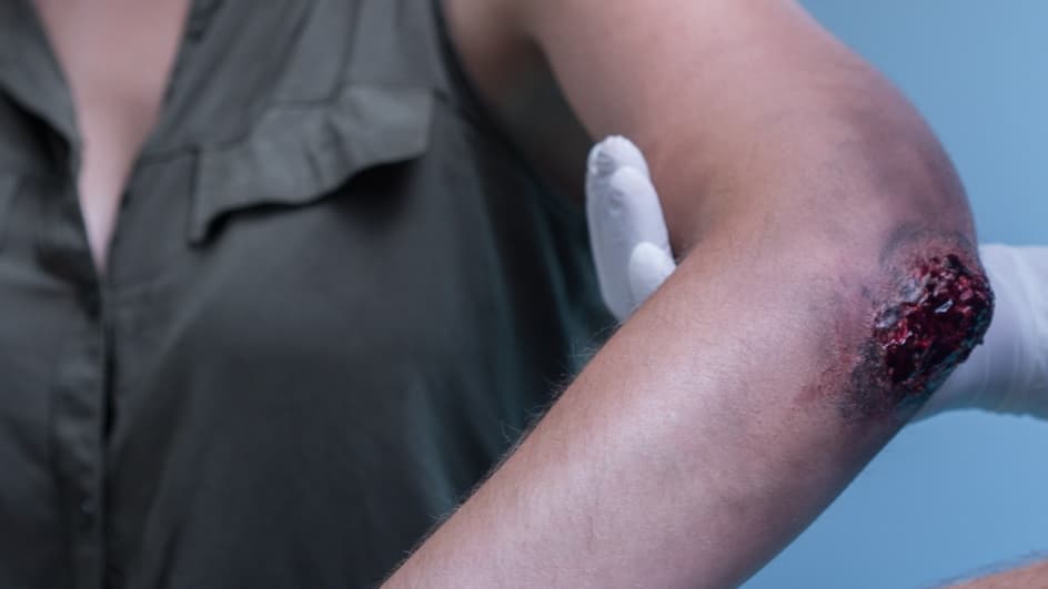 Thumbnail for Introduction to Wound Care