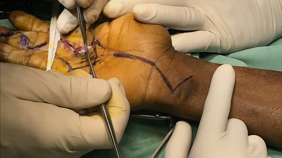 Thumbnail for Hand Tumours and Reconstruction