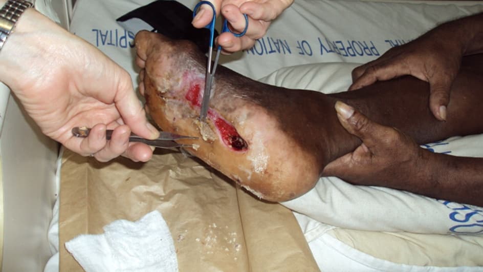 Thumbnail for Diabetic Foot Series l Part 1