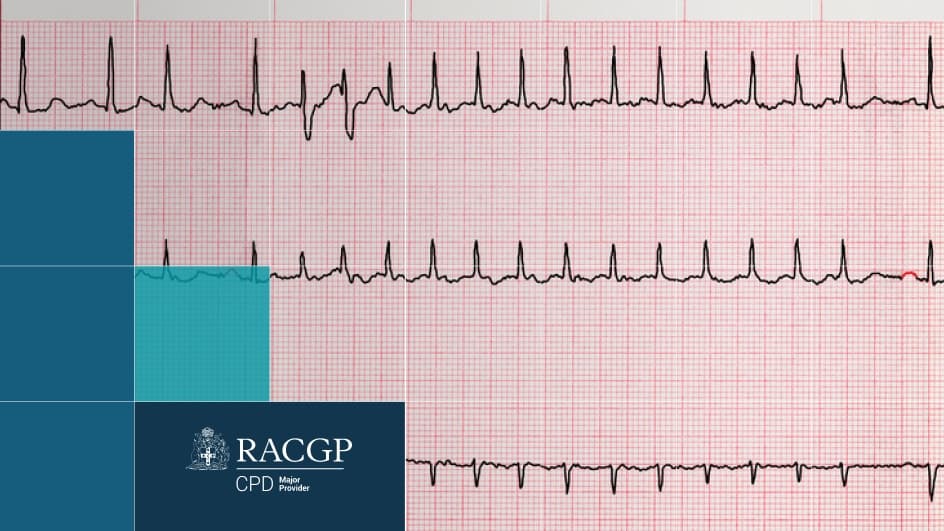 Thumbnail for Cardiac Care 'Young AF and Chest pain at 50' 