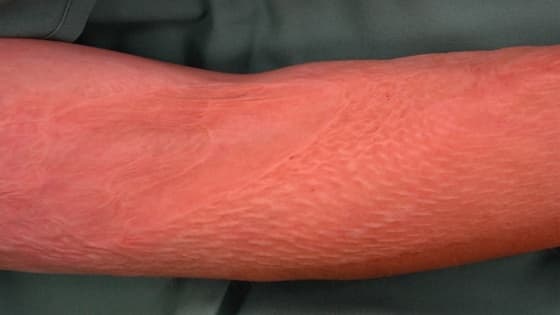 Thumbnail for Principles of skin grafting