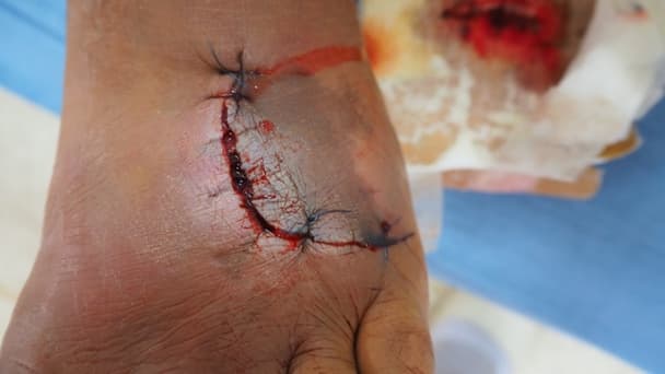 Thumbnail for Scar Management