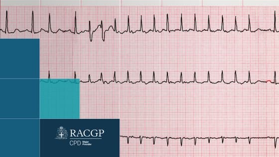 Thumbnail for Cardiac Care 'Young AF and Chest pain at 50' 