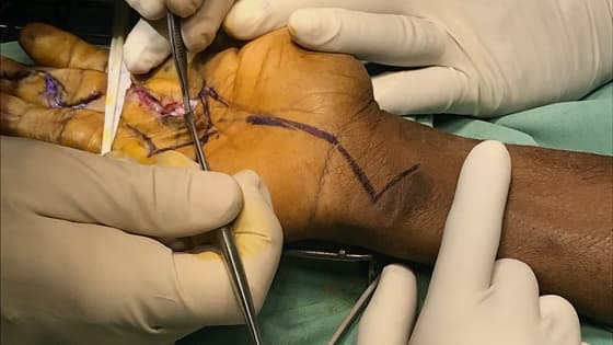 Thumbnail for Hand Tumours and Reconstruction