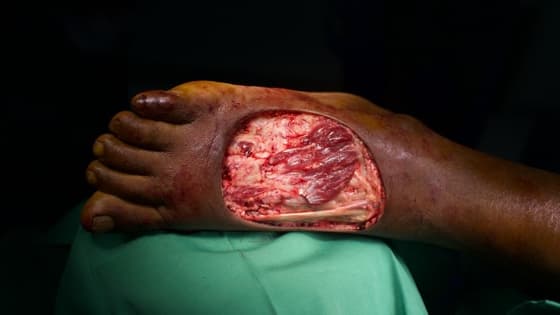 Thumbnail for Free Flap Selection