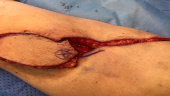 Thumbnail for Principles of Plastic Surgery: Blood Supply