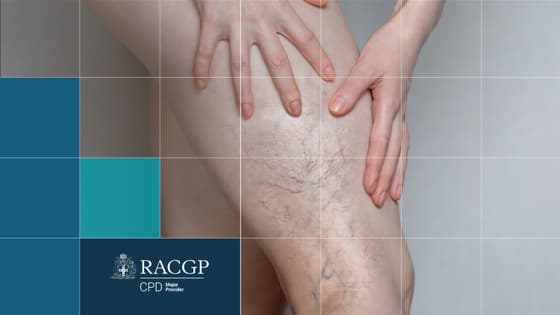 Thumbnail for Contemporary Management of Venous Disease