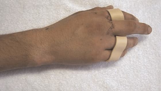 Thumbnail for Rehabilitation after extensor tendon injury in the hand