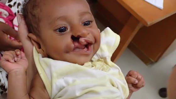Thumbnail for Feeding an Infant with Cleft Lip/Palate