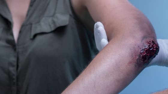 Thumbnail for Introduction to Wound Care