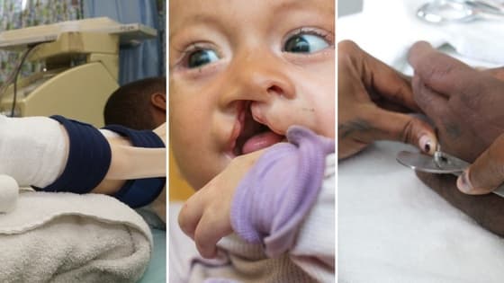 Thumbnail for Introduction to allied health management of Hands, Burns and Cleft Palate