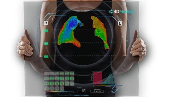 Thumbnail for CT Lung Functional & Ventilation Analysis