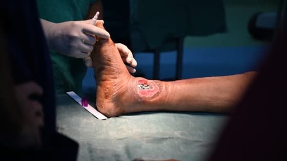 Thumbnail for Principles of Plastic Surgery: Lower Limb Reconstruction