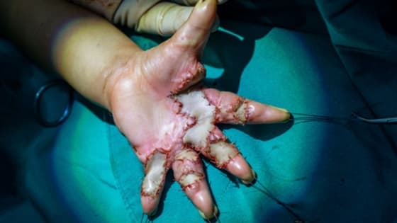 Thumbnail for Skin Graft Care and Management