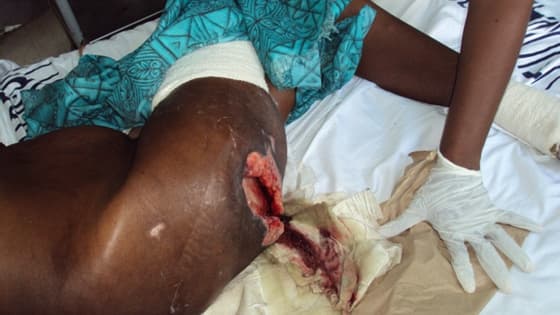 Thumbnail for Wound Management Series l Part 3