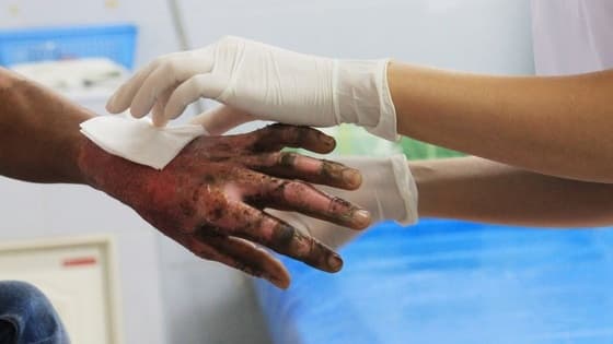 Thumbnail for Actions Optimising Outcomes In Burn Injured Patients