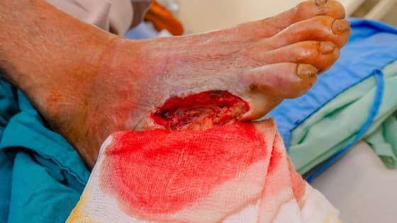 Thumbnail for Wound closure l Part 2: Local and simple flaps to close wound defects