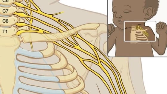 Thumbnail for Brachial plexus birth palsy