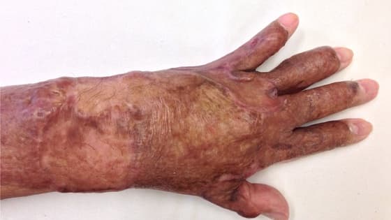 Thumbnail for Burn Contracture, prevention and surgical management in limited resources setting