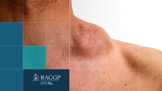 Thumbnail for Lymphoma - Everything you need to know