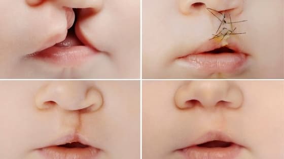 Thumbnail for Nursing care of the cleft lip and palate patient