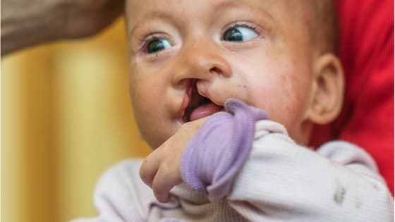 Thumbnail for The impact of cleft lip and palate on early communication development