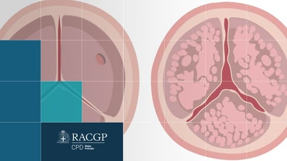 Thumbnail for Aortic Stenosis - Symptoms, Causes, Management, Treatment