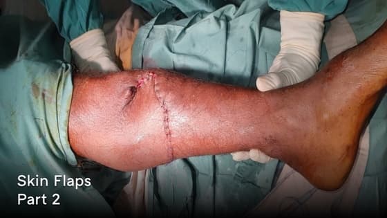 Thumbnail for Skin Flaps - An algorithm of an approach to flap failure