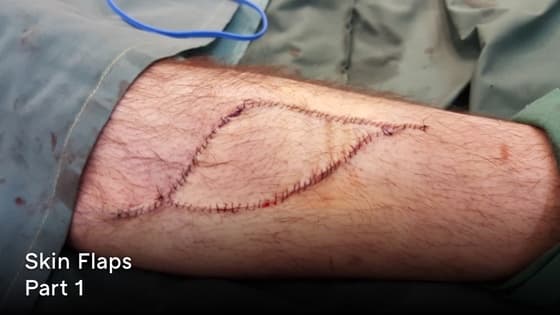 Thumbnail for Skin Flaps - Principles of Flap Repair