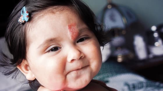 Thumbnail for Hemangiomas and Vascular Malformations: Principles and Practice