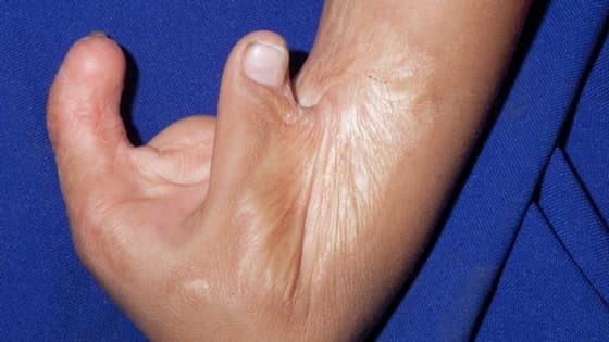 Thumbnail for Treatment of Burns Scar Contracture