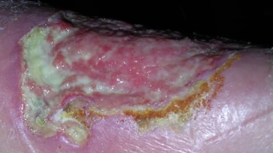 Thumbnail for Wound Solutions