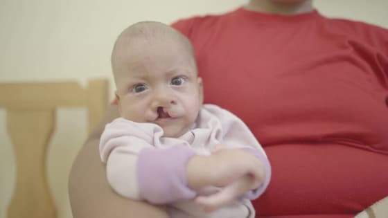 Thumbnail for Feeding a Baby With a Cleft Lip and Palate